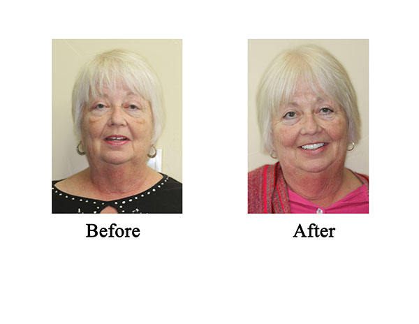 Before & After | Lake Texoma Dental Care & Wellness